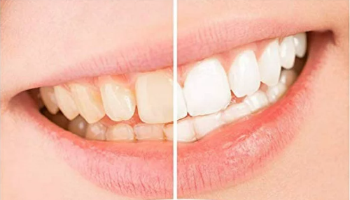 Natural Teeth Whitening: Unveiling the Secrets to a Brighter Smile